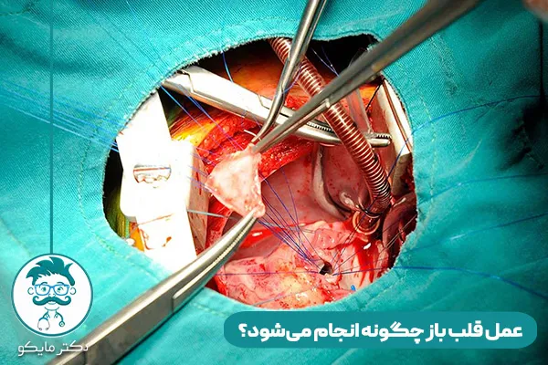 عمل قلب باز