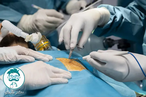 عمل قلب باز برای گرفتگی رگ