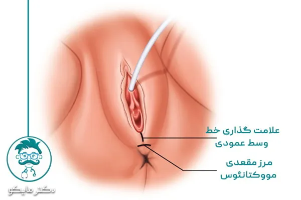 عوارض جراحی پرینورافی