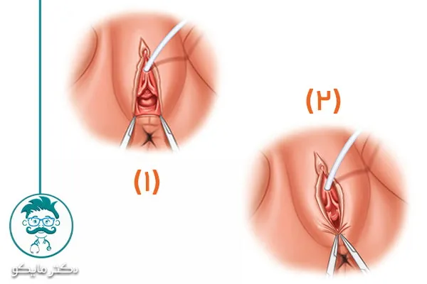 عمل پرینورافی چگونه انجام می شود؟