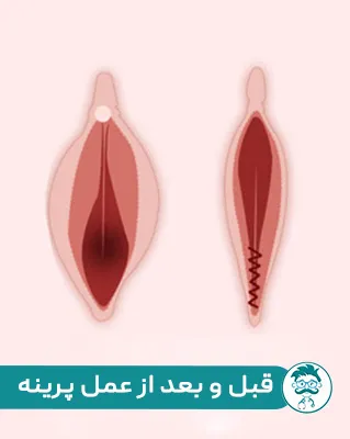 ماندگاری عمل پرینورافی چقدر است؟