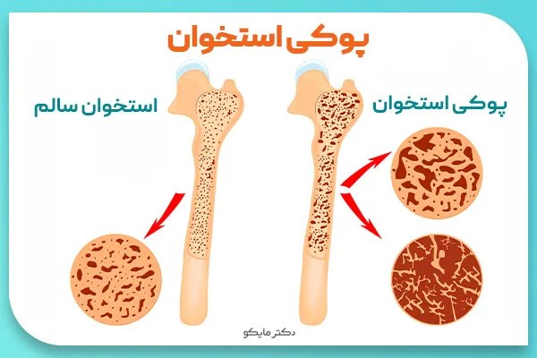 پوکی استخوان در زنان و مردان