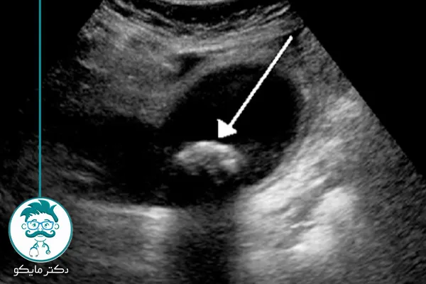 آیا سنگ کیسه صفرا باعث لاغری می‌شود؟