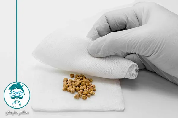 عمل سنگ کیسه صفرا