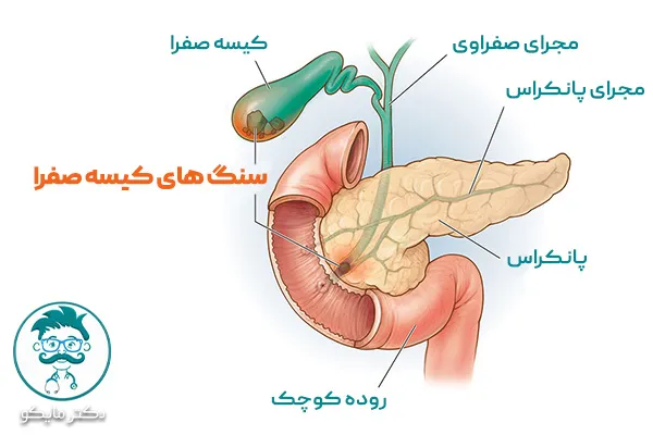 سنگ کیسه صفرا چیست؟