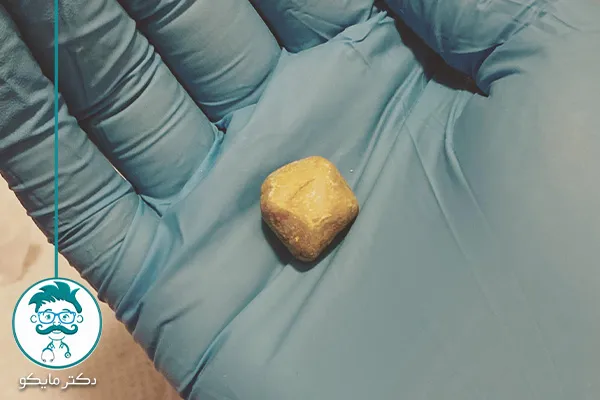 سنگ کیسه صفرا