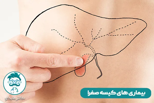 بیماری های کیسه صفرا