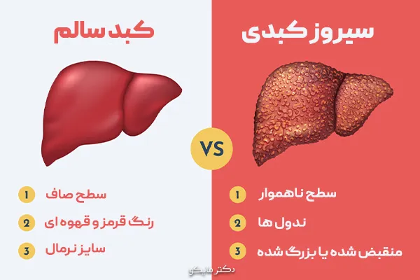 درصد درمان سیروز کبدی: آیا سیروز کبدی خوب میشه؟