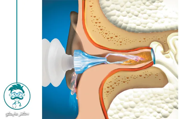 مزایا و عوارض شستشوی گوش چیست؟