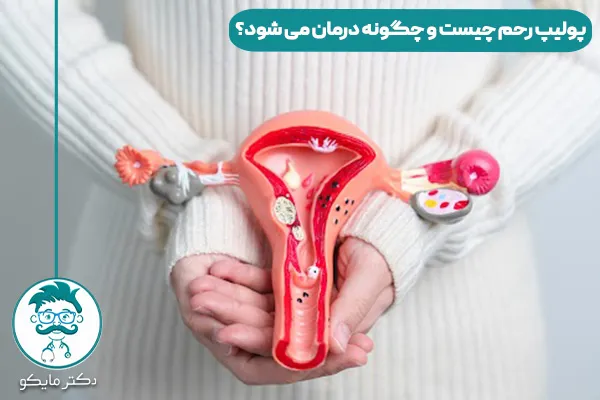 پولیپ رحم چیست و چگونه درمان می شود؟