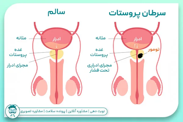 سرطان پروستات در مردان