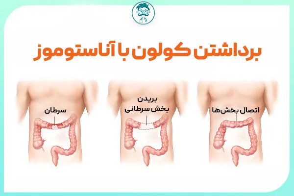 برداشتم بخش توده ی سرطانی روده