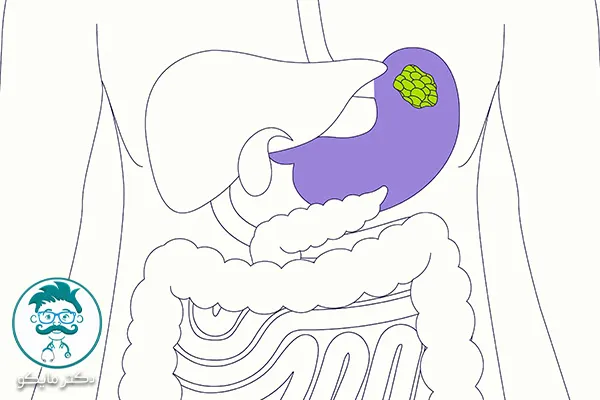 از کجا بفهمیم سرطان معده داریم؟