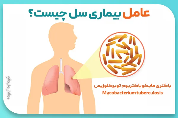 علت و عامل بیماری سل