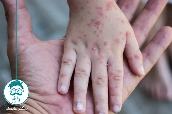 درمان خانگی سرخجه در کودکان