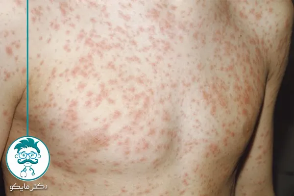 تصاویر بیماری سرخجه