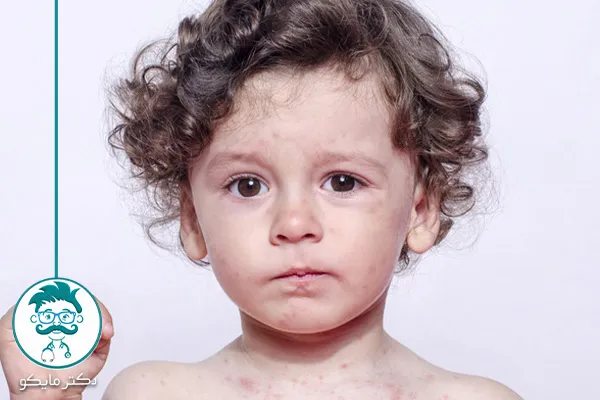 درمان سرخجه در بارداری