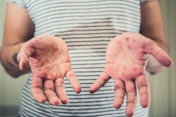 سرخجه چیست و چه شکلیه؟ تصاویر علائم و درمان سرخجه در کودکان و بزرگسالان
