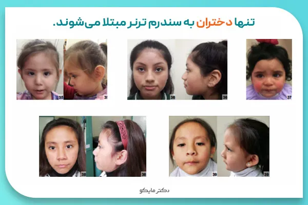 سندرم ترنر در دختران