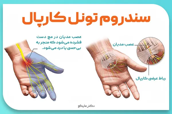 سندرم تونل کارپال دست