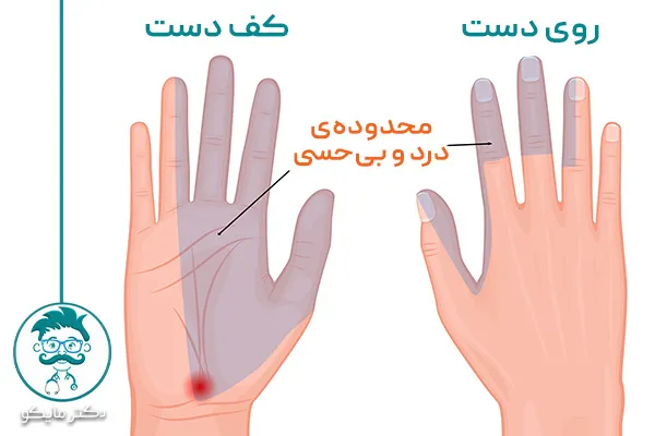 درد دست سندرم تونل کارپال
