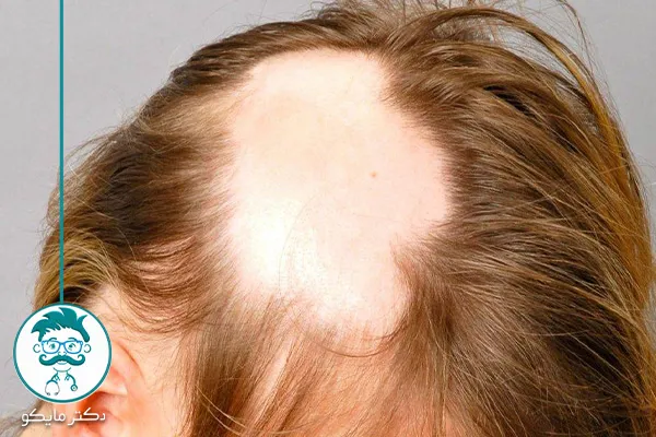 ریزش مو سکه‌ ای در زنان