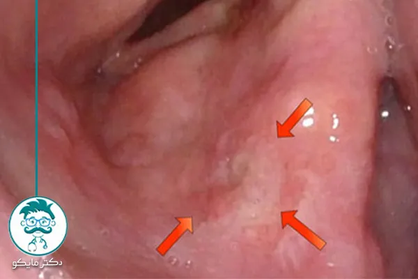 عکس سرطان حنجره