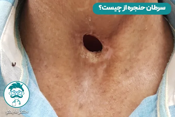 سرطان حنجره چیست؟ 