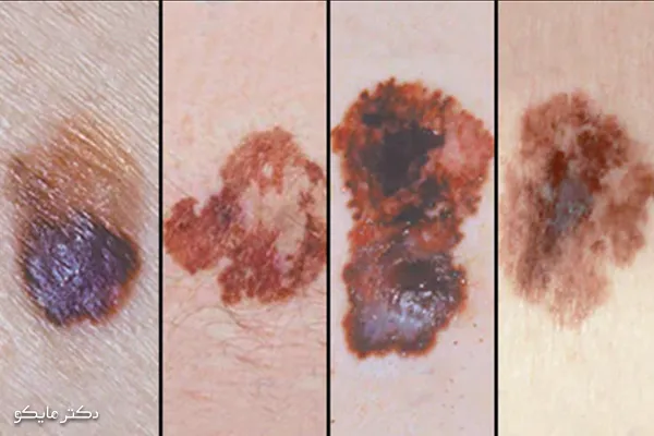 آیا سرطان ملانوما قابل درمان است؟