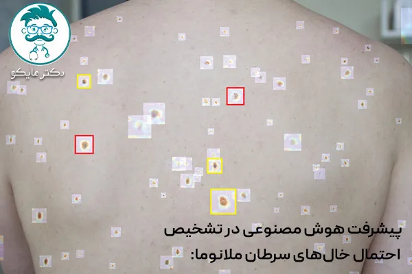 سرطان ملانوم