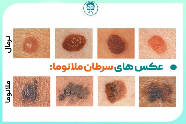 عکس سرطان ملانوما