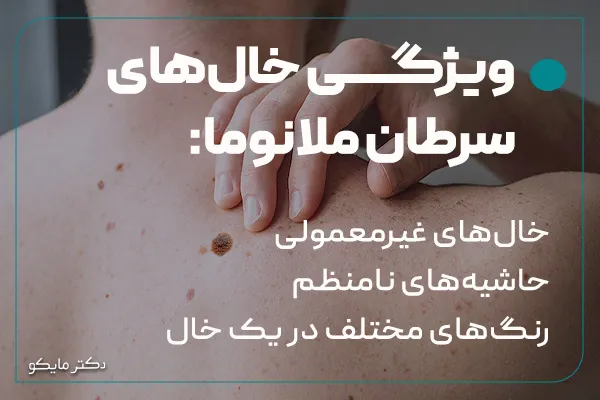 ویژگی خال‌های ملانوما