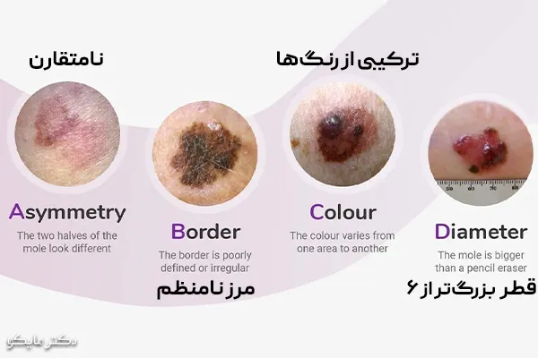 علائم سرطان ملانوما