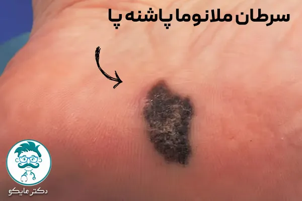 سرطان ملانوما پاشنه پا