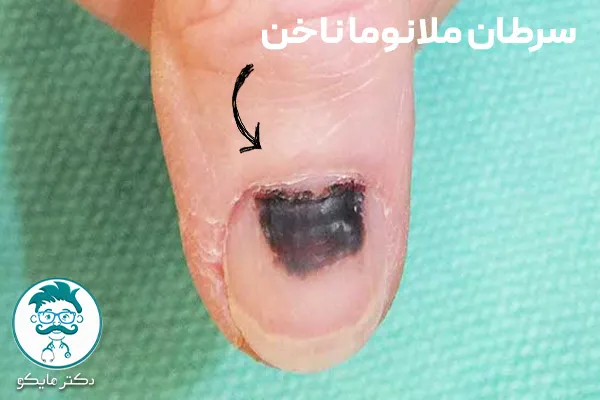 سرطان ملانوما ناخن