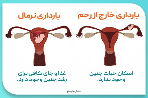 بارداری خارج از رحم یعنی چی؟