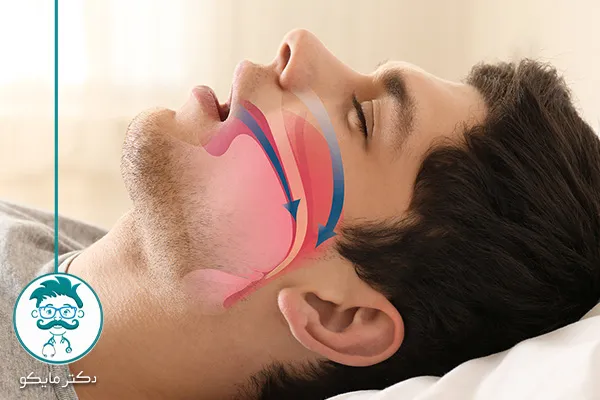 خُرخُر کردن و آپنه خواب