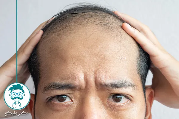 ریزش مو هورمونی چگونه است؟