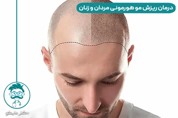 ریزش مو هورمونی یعنی چه؟ 