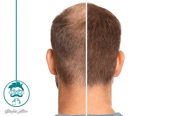 قرص برای ریزش مو هورمونی