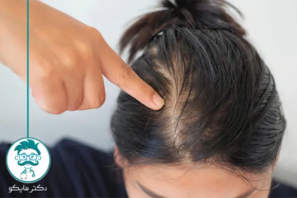 از کجا بفهمیم ریزش مو هورمونی است؟