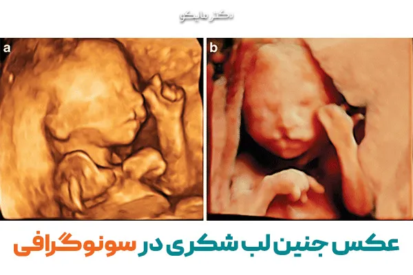 عکس جنین لب شکری در سونوگرافی