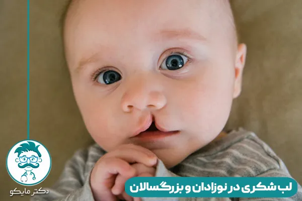 لب شکری نوزاد و بزرگسال