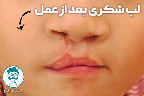 لب شکری بعد از عمل