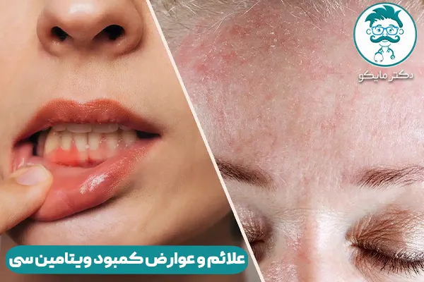 کمبود ویتامین سی
