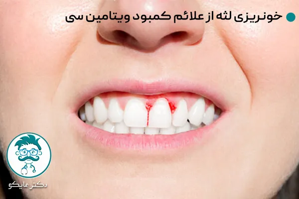 کمبود ویتامین C و خونریزی لثه