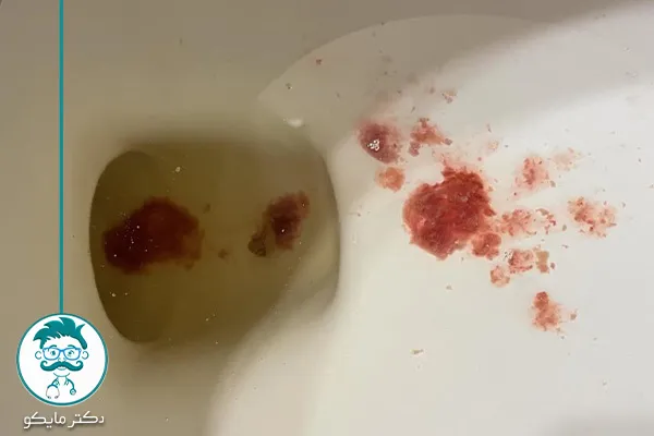 عکس اسهال خونی
