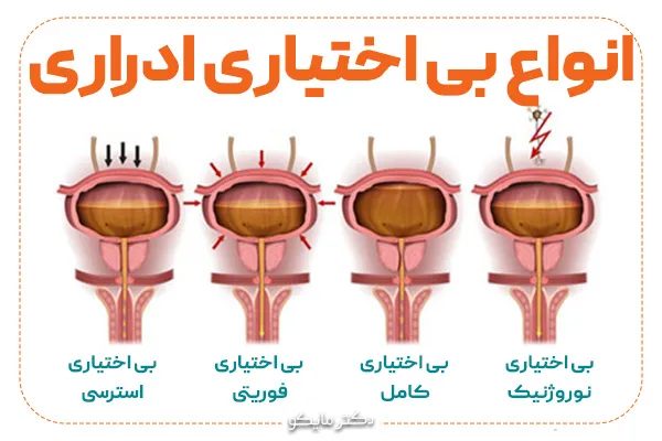 انواع بی ‌اختیاری ادراری