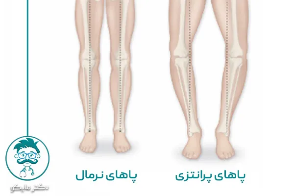 عکس پای پرانتزی و سالم