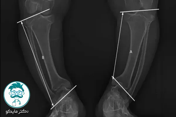 علت پرانتزی شدن پا در بزرگسالی